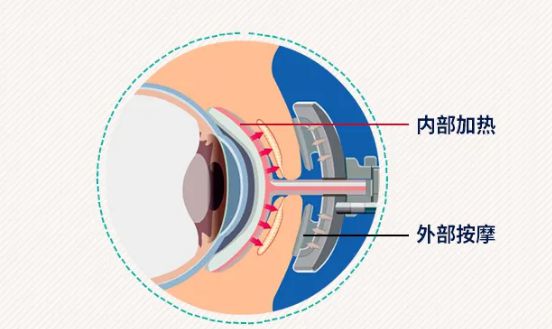 神奇“黑科技”你了解吗？尊龙凯时网站这款干眼治疗(图4)